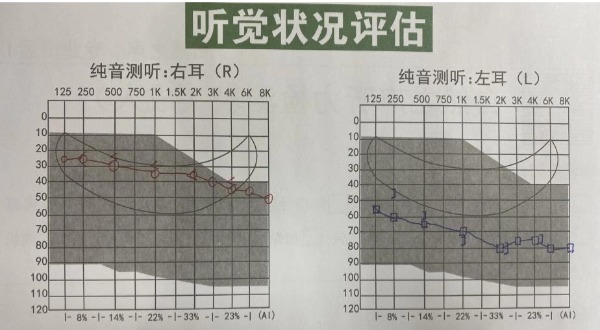 听力障碍改善案例：王叔叔的双耳助听器选配经历！